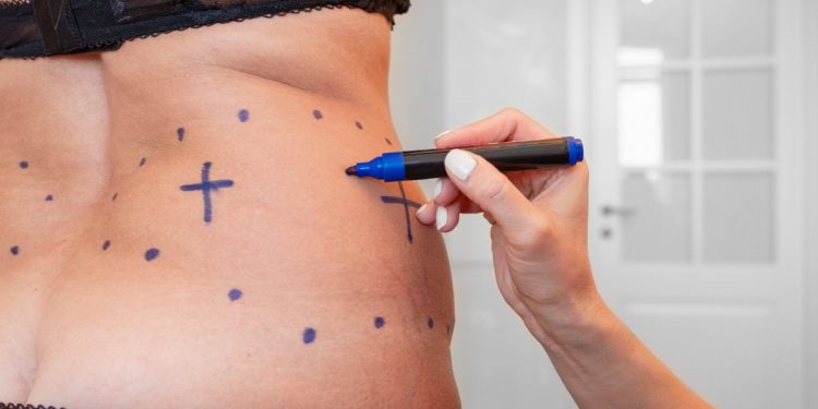 donna in mutande e reggisono di schiena che si fa disegnare dal chirurgo le zone che andrà a perdere durante la liposuzione