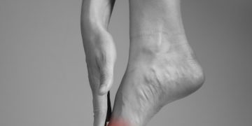 Neuroma di Morton: che cos'è. sintomi e cause, diagnosi e cure