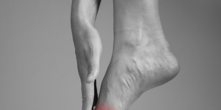 Neuroma di Morton: che cos'è. sintomi e cause, diagnosi e cure