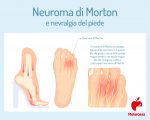 Laserterapia Per Neuroma Di Morton è La Soluzione Definitiva - Foto 2