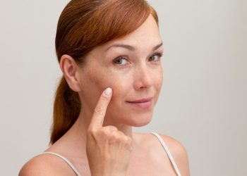 Una donna che indica delle macchie sul viso per poca o troppa melanina