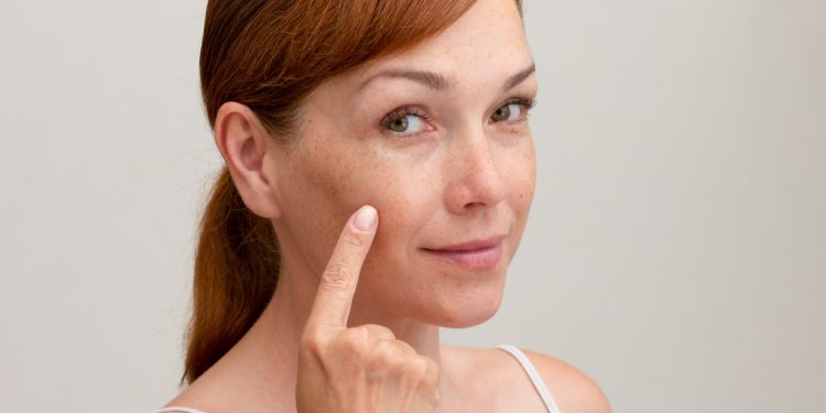 Una donna che indica delle macchie sul viso per poca o troppa melanina