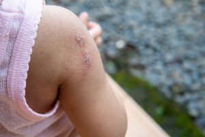 Cellulite infettiva: che cos’è, cause, sintomi e cure