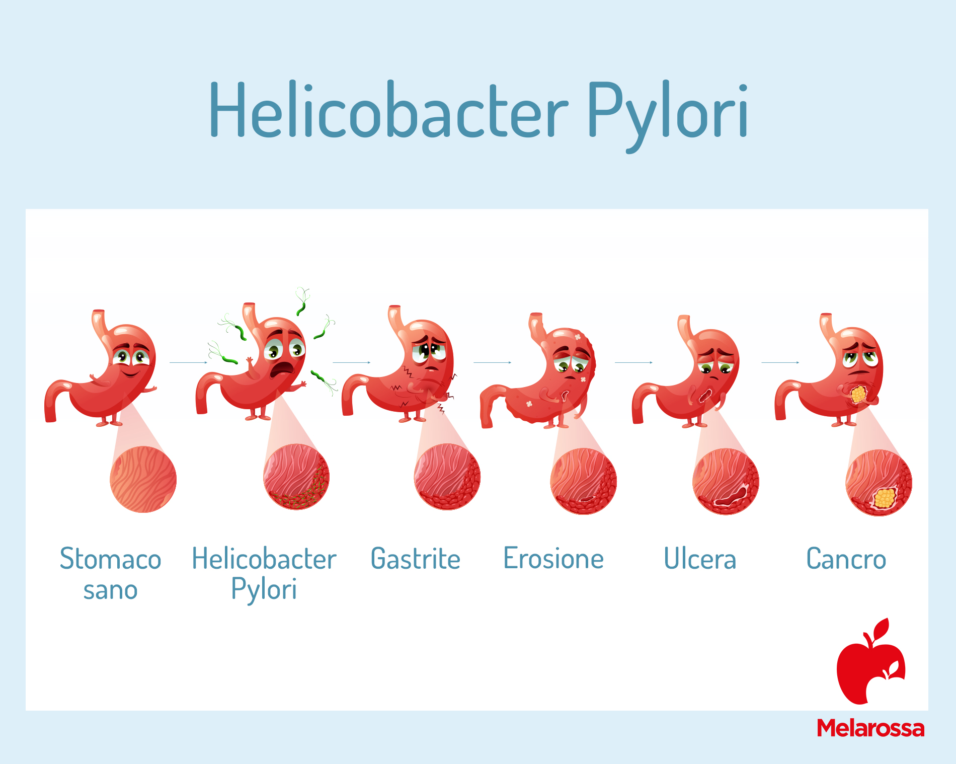 helicobacter pylori: sintomi 