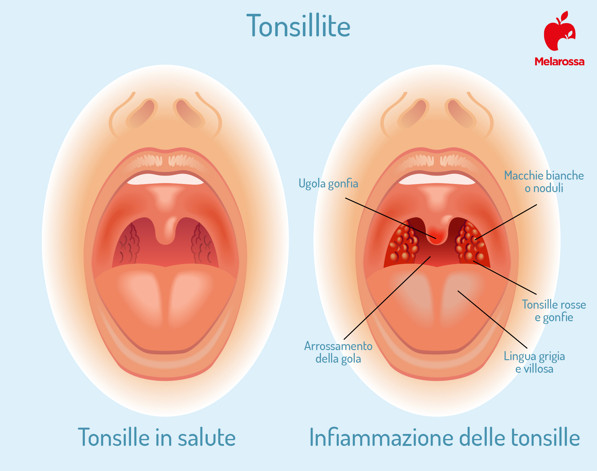 placche in gola: infiammazione delle tonsille 