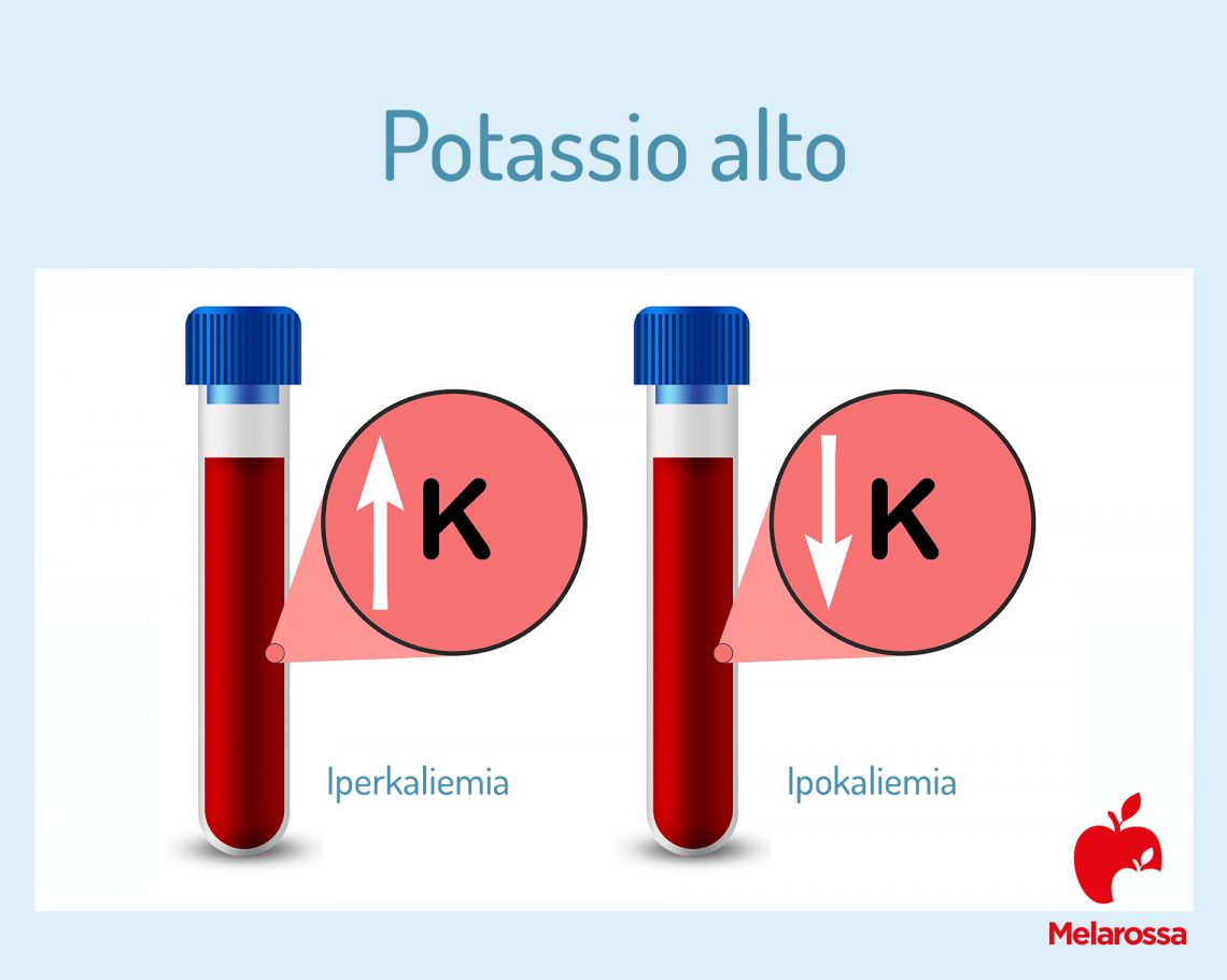 Potassio alto nel sangue o iperkaliemia: sintomi, cause, cure