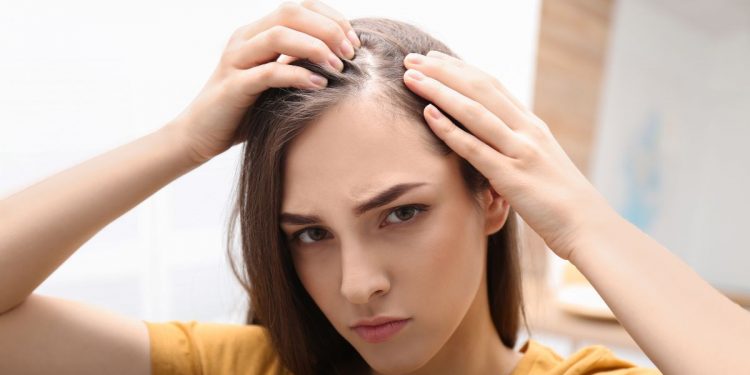 alopecia femminile