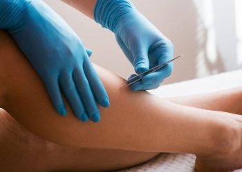 peli incarniti: una donna che toglie un pelo incarnito dalla gamba con le pinzette