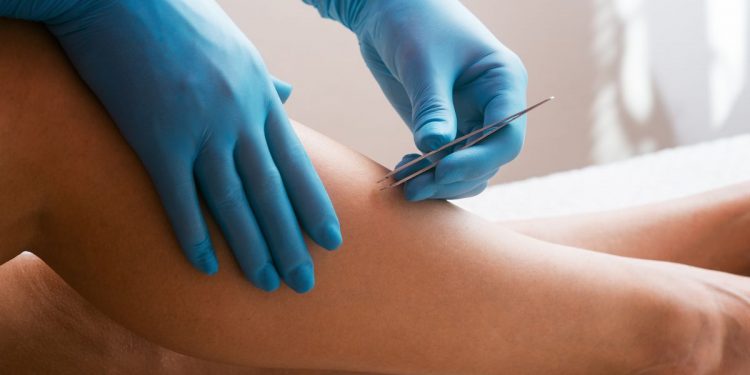 peli incarniti: una donna che toglie un pelo incarnito dalla gamba con le pinzette