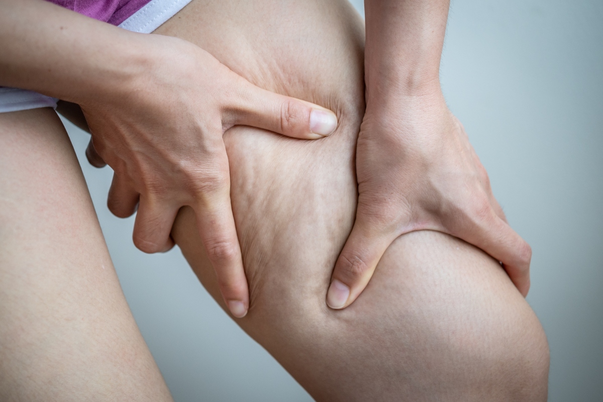 Cellulite: cos’è, cause e tipologie e come riconoscerla