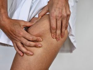 Cellulite fibrosa: sintomi, cause e trattamenti efficaci